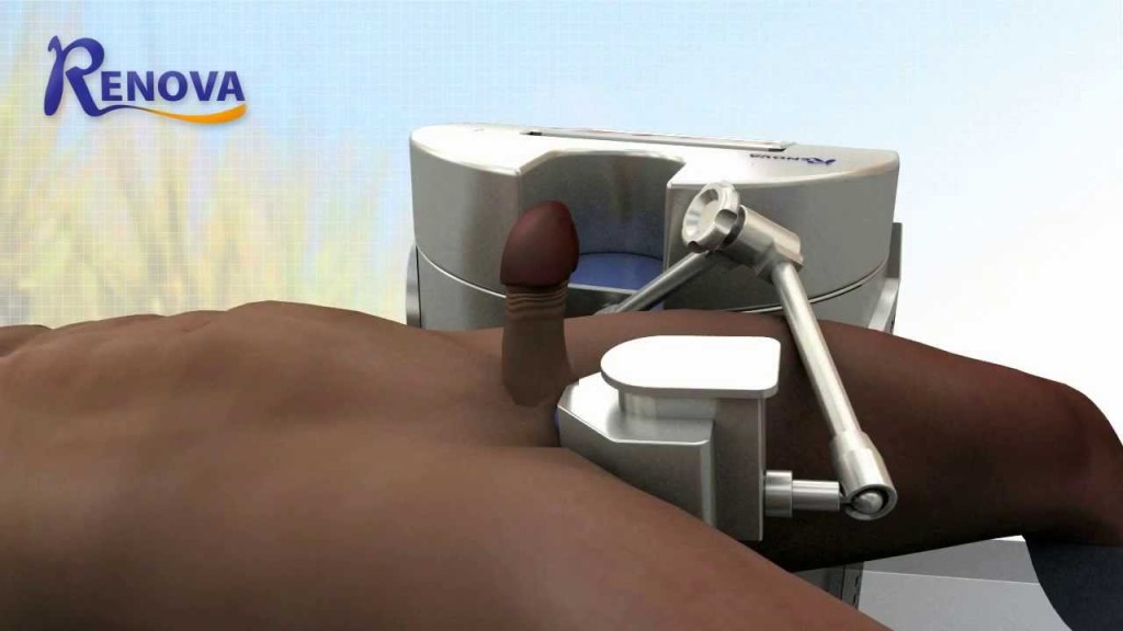 Linear Shockwave Therapy - LSWT