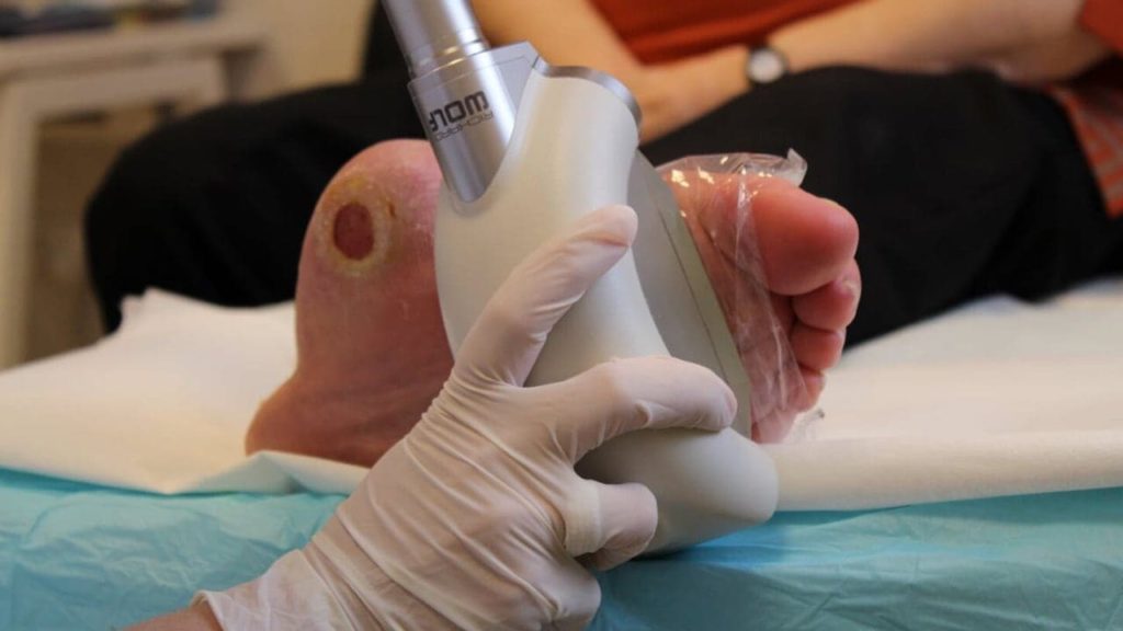 Lökéshullám-terápia: egy új és hatékony lehetőség a cukorbeteg láb kezelésében